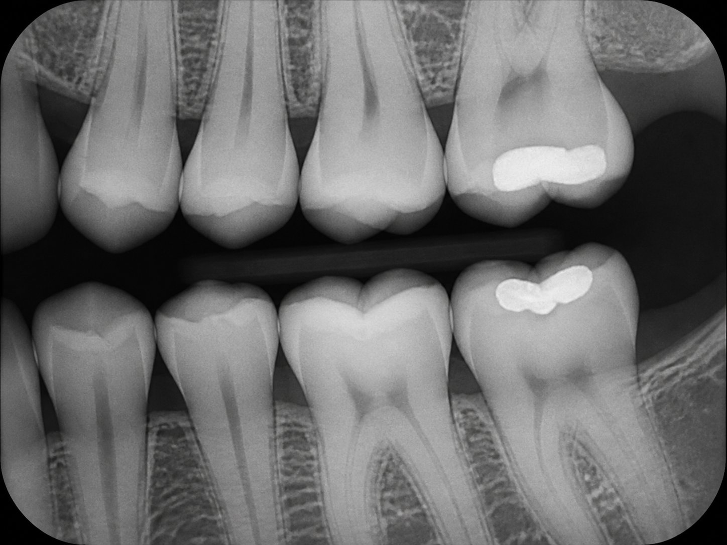 Posterior dental bitewing radiograph